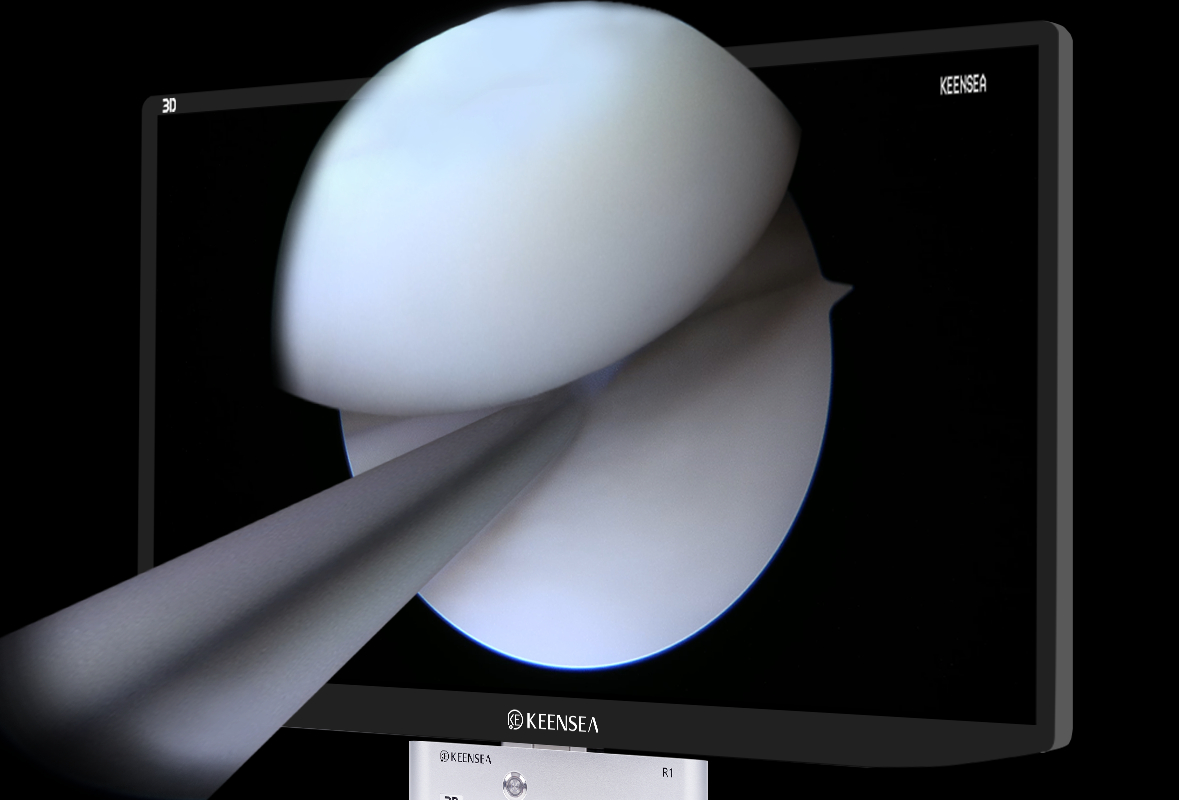 j9.com九游会医疗助力上海十院成功完成首例3D关节镜下臀肌挛缩松解术--同济医院 j9.com九游会医疗助力上海十院成功完成首例3D关节镜下臀肌挛缩松解术--同济医院